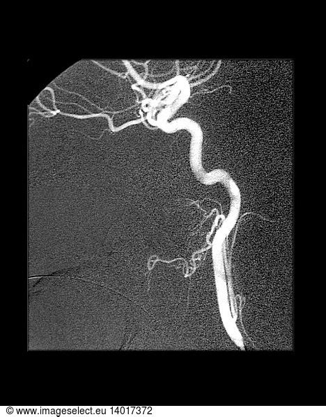 Internal Carotid Artery Internal Carotid Artery, Angiogram,angiography ...