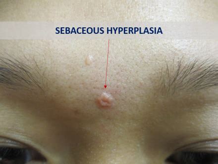 Sebaceous Glands Hyperplasia Photos and Treatment