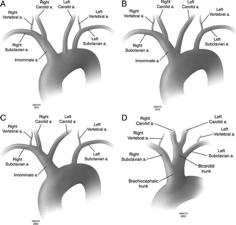 Figure 1. bovine arch and other aortic arch variations | Medical ...