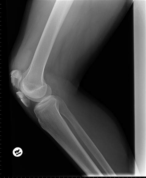 Patellar fracture: comminuted | Image | Radiopaedia.org