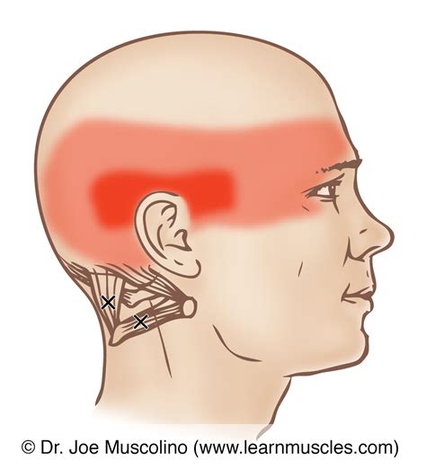 Suboccipital Group - Trigger Points - Learn Muscles