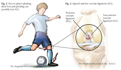 Acl Tear Football