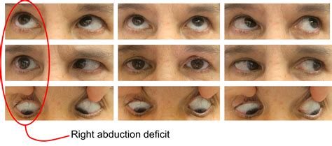 Sixth nerve palsy – Case-Based Neuro-Ophthalmology