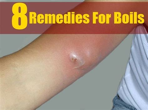 Remedy For Boils Check more at http://www.healthyandsmooth.com/boils ...