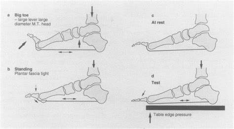 (a) Dorsiflexion of the big toe and the windlass effect of the plantar ...