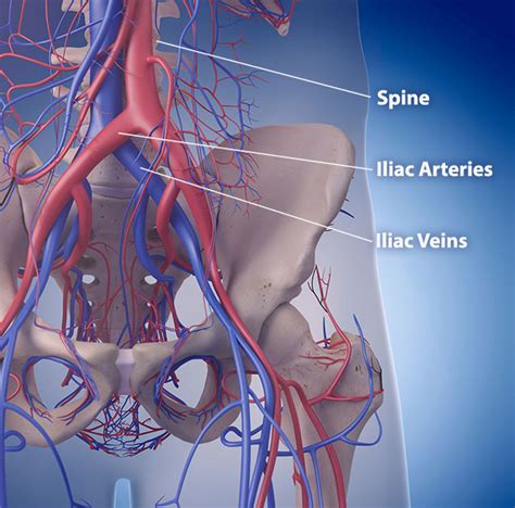 Iliocaval IVUS and Stenting - Cardiovascular Institute of the Shoals