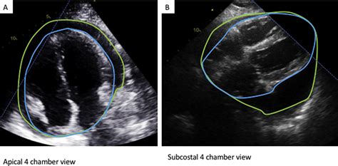 Echocardiographic Assessment of Pericardial Effusion Size: Time for a Quantitative Approach ...