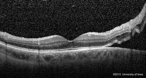 Retinal Detachment: From One Medical Student to Another