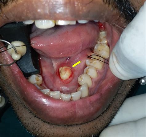 Cureus | Sialolithiasis of the Submandibular Gland: Report of Cases