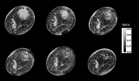 Clinical Research Highlights - Ultrasound Tomography Center