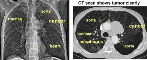 Normal Lung Anatomy