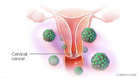 Mayo Clinic Q and A: Importance of cervical cancer screening with HPV test, Pap test or both ...