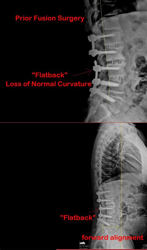 Flatback Syndrome | Manhattan Spine Consultants