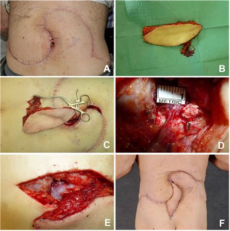 Fasciocutaneous infragluteal free flap (FCI). (A) Remaining lumbar... | Download Scientific Diagram