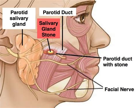 parotid-salivary-gland-duct-stone - Otolaryngology Specialists of North Texas