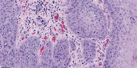 Laryngeal Papilloma Histology