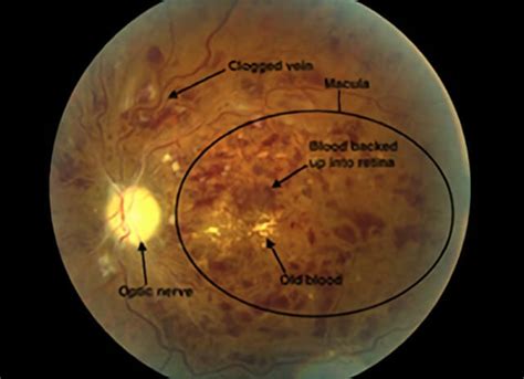 Central Vein Occlusion Treatment | Retinal Consultants Medical Group