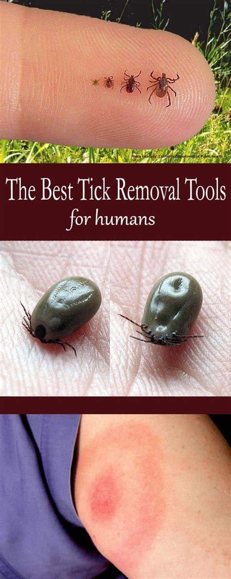 The Best Tick Removal Tools for Humans - Mom Goes Camping in 2020 ...