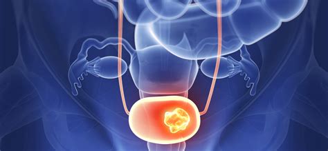 The Fascinating Story Behind a New Bladder Cancer Treatment | Johnson & Johnson