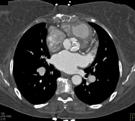 Aortic Valve Disease and Mitral Valve Replacement - Cardiac Case Studies - CTisus CT Scanning