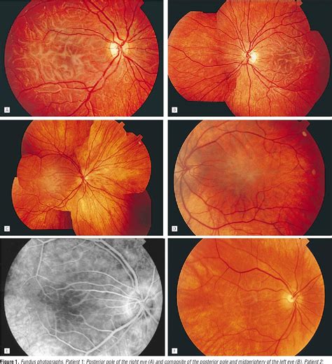 Figure 1 from Cone-rod dystrophy with serpentine-like retinal deposits. | Semantic Scholar