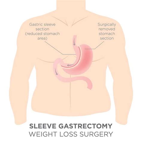 Gastric Sleeve Surgery | Weight loss, Procedure & Cost - The HealthUp