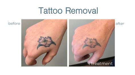 Laser Tattoo Removal in Chandler, AZ | Free Consultation — Lazaderm Laser & Aesthetics