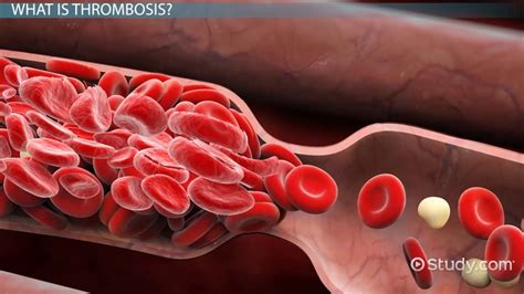 What Is Thrombosis? - Definition, Symptoms & Treatment - Lesson | Study.com