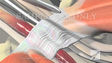 Carpal Tunnel Syndrome with Surgical Release - YouTube