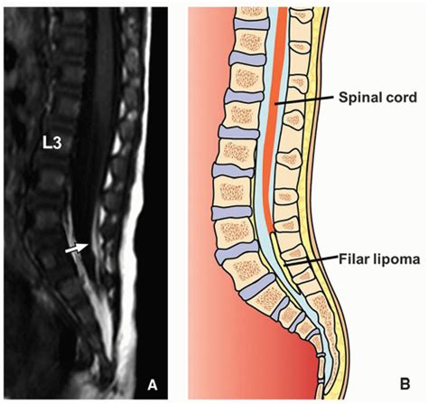 Spinal Cord | Radiology Key