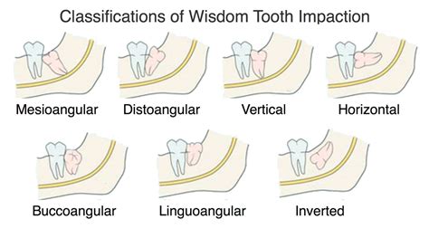 Wisdom Tooth Impaction in Ventura, CA - Pacific Oral Surgery