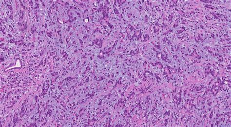 desmoplasia Archives | Atlas of Pathology