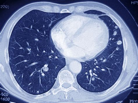 Medicare Poised To Cover CT Scans To Screen For Lung Cancer : Shots - Health News : NPR