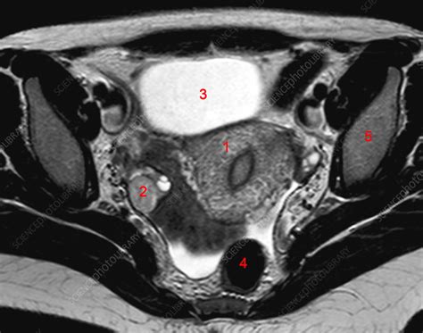 Mri Female Pelvis Anatomy