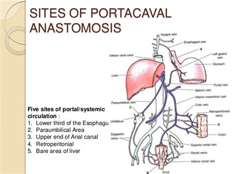 Image - Portacaval-anastomosis-6-638.jpg | RANZCRPart1 Wiki | FANDOM powered by Wikia