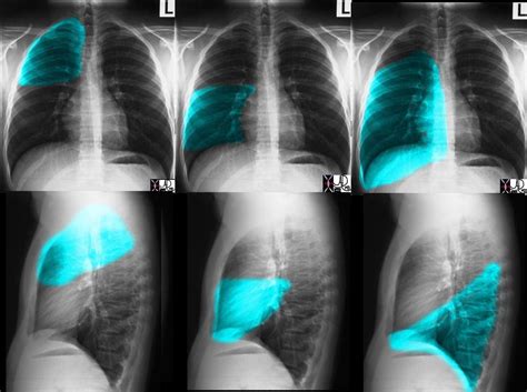 Chest X Ray Lung Parts And Fissures Cxr Lungs | SexiezPicz Web Porn