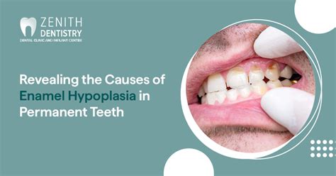 Revealing the Causes of Enamel Hypoplasia in Permanent Teeth | Zenith ...