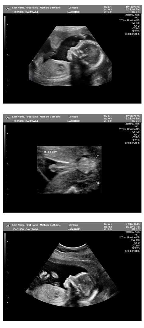 3-Fetuses 22 Weeks Ultrasound: Boy - Ultrasounds