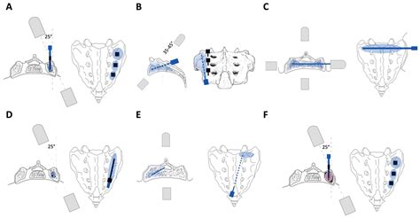 Sacroplasty for Sacral Insufficiency Fractures: Narrative Literature Review on Patient Selection ...