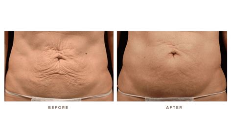 Thermage Body Before and Afters | Infinity Skin Clinic Sydney