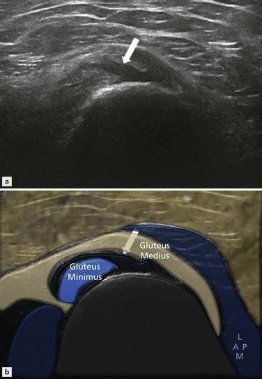 Gluteus Medius Bursitis