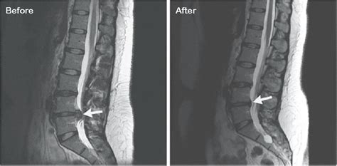 Spinal Traction is Used to Treat Herniated Spinal Discs