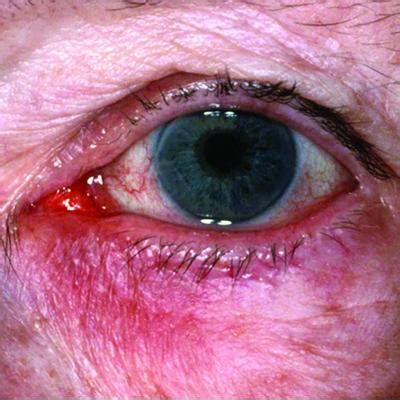 Ocular rosacea remains a stubborn foe | MDedge Internal Medicine