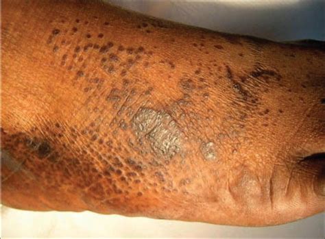 Hyperkeratosis