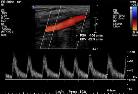 Occluded Carotid Artery