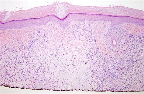 Atypical Fibroxanthoma | Dermatopathology