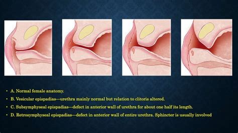 Hypospadias, epispadias and bladder exstrophy | PPT