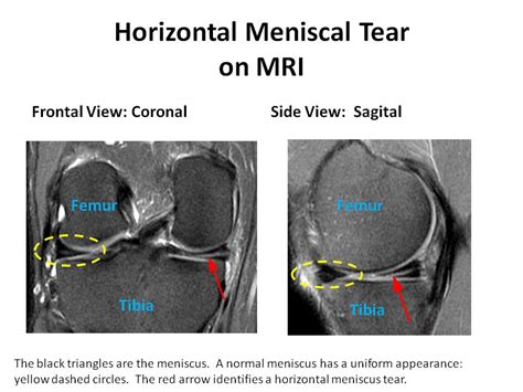 Meniscus Anatomy Mri