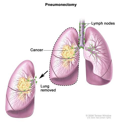 Lung Cancer Drawing at GetDrawings | Free download