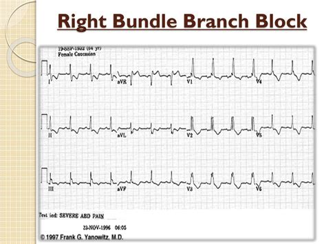 PPT - BUNDLE BRANCH BLOCK PowerPoint Presentation, free download - ID ...